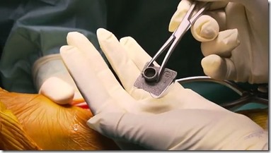 Médecine : on utilise désormais les imprimantes 3D pour les opérations à la cheville